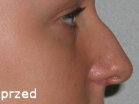 nos1a Plastyka nosa